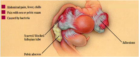 sintomi malattia infiammatoria pelvica