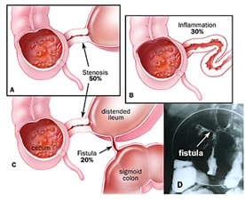 Sintomi Morbo Crohn