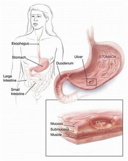 sintomi ulcera duodenale