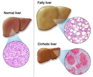 steatosi epatica