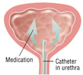 terapia cistite interstiziale