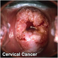 tumore cervice HPV