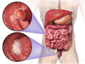 Tumore del Colon Retto