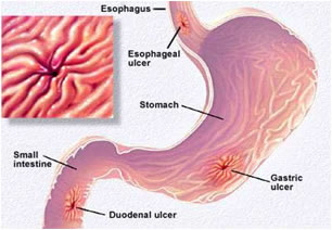 ulcera gastrica