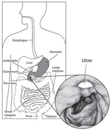 Ulcera stomaco